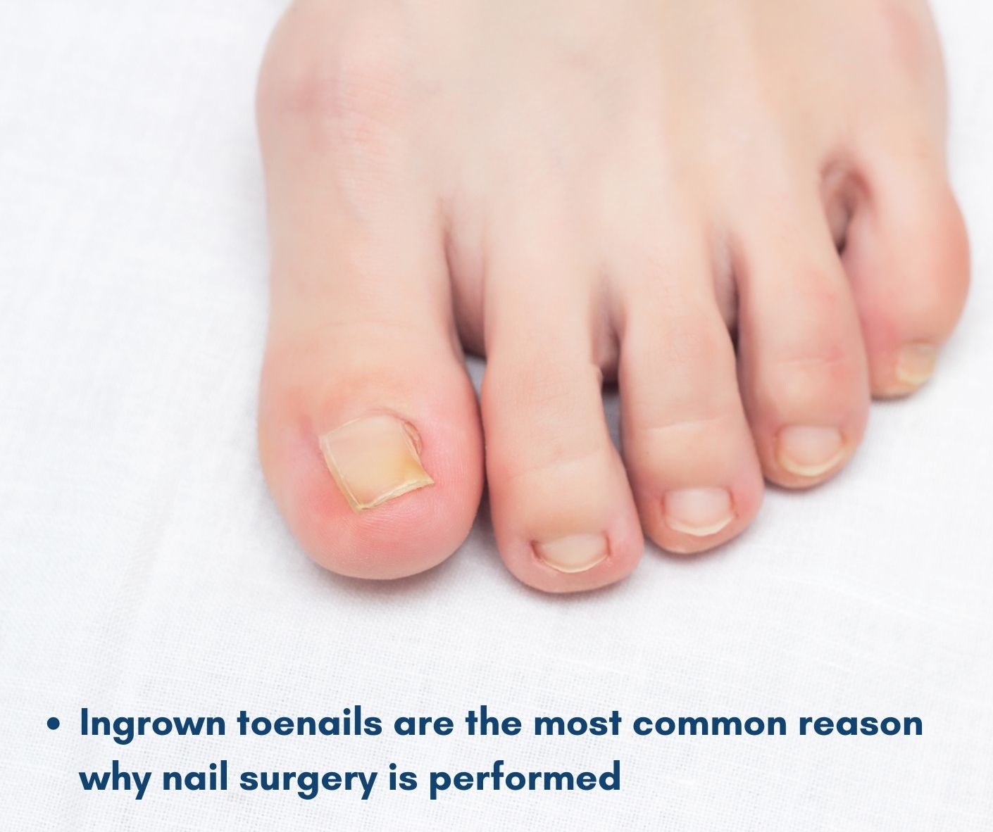 Toenail Surgery: A Complete Guide For Patients